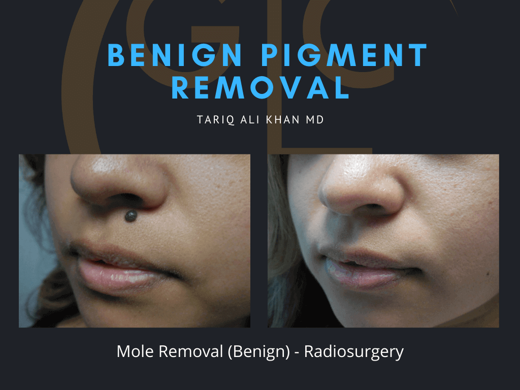 Gentle Care Laser Tustin & Long Beach Before and After picture - Mole Removal